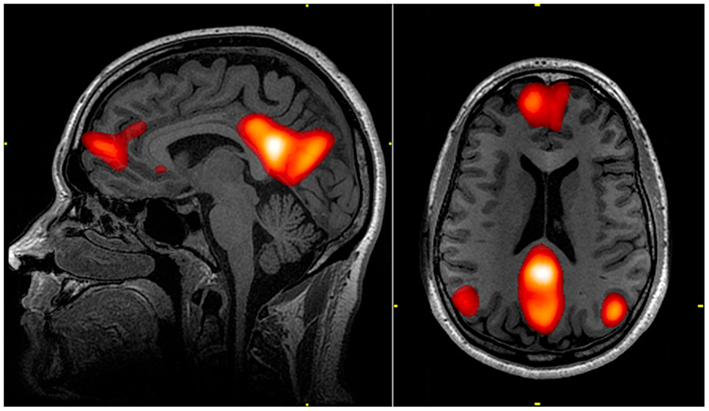 MRI showing the brain areas that make up the DMN.
